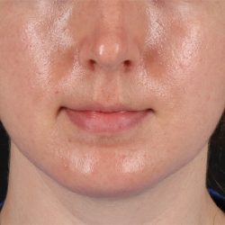 Chin Implant Before & After Patient #13761