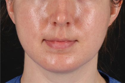 Chin Implant Before & After Patient #13761