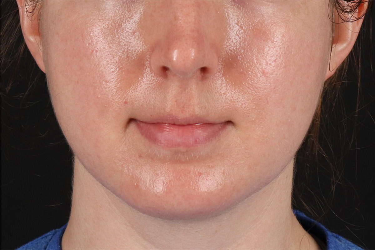 Chin Implant Before & After Patient #13761