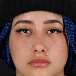Rhinoplasty Before & After Patient #12491