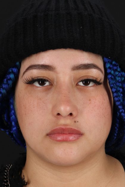 Rhinoplasty Before & After Patient #12491