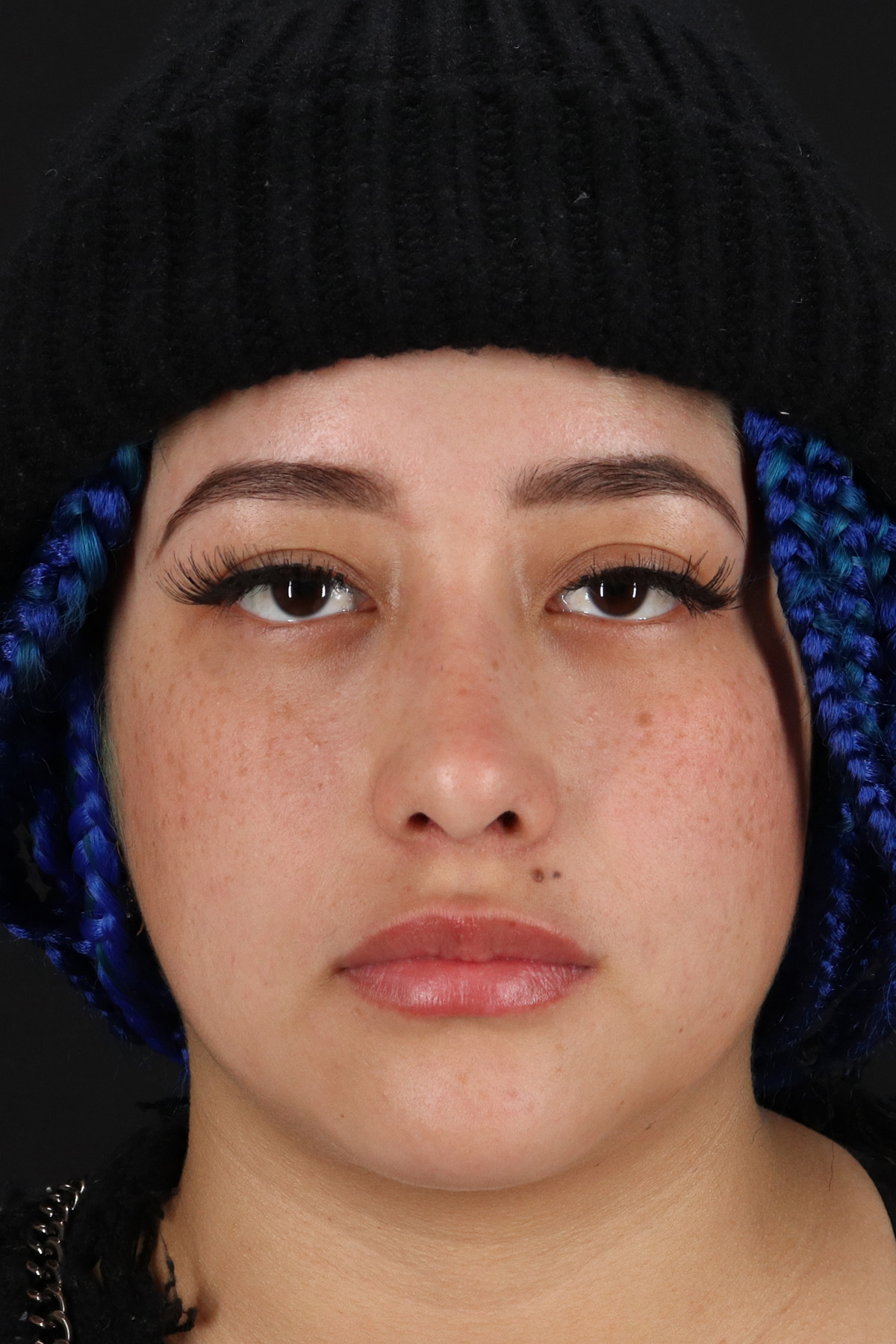 Rhinoplasty Before & After Patient #12491
