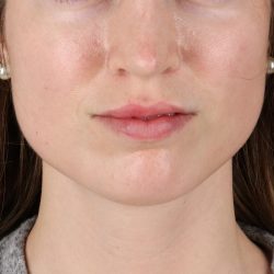 Buccal Fat Pad Before & After Patient #14025