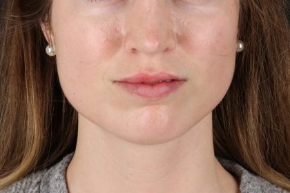 Buccal Fat Pad Before & After Patient #14025