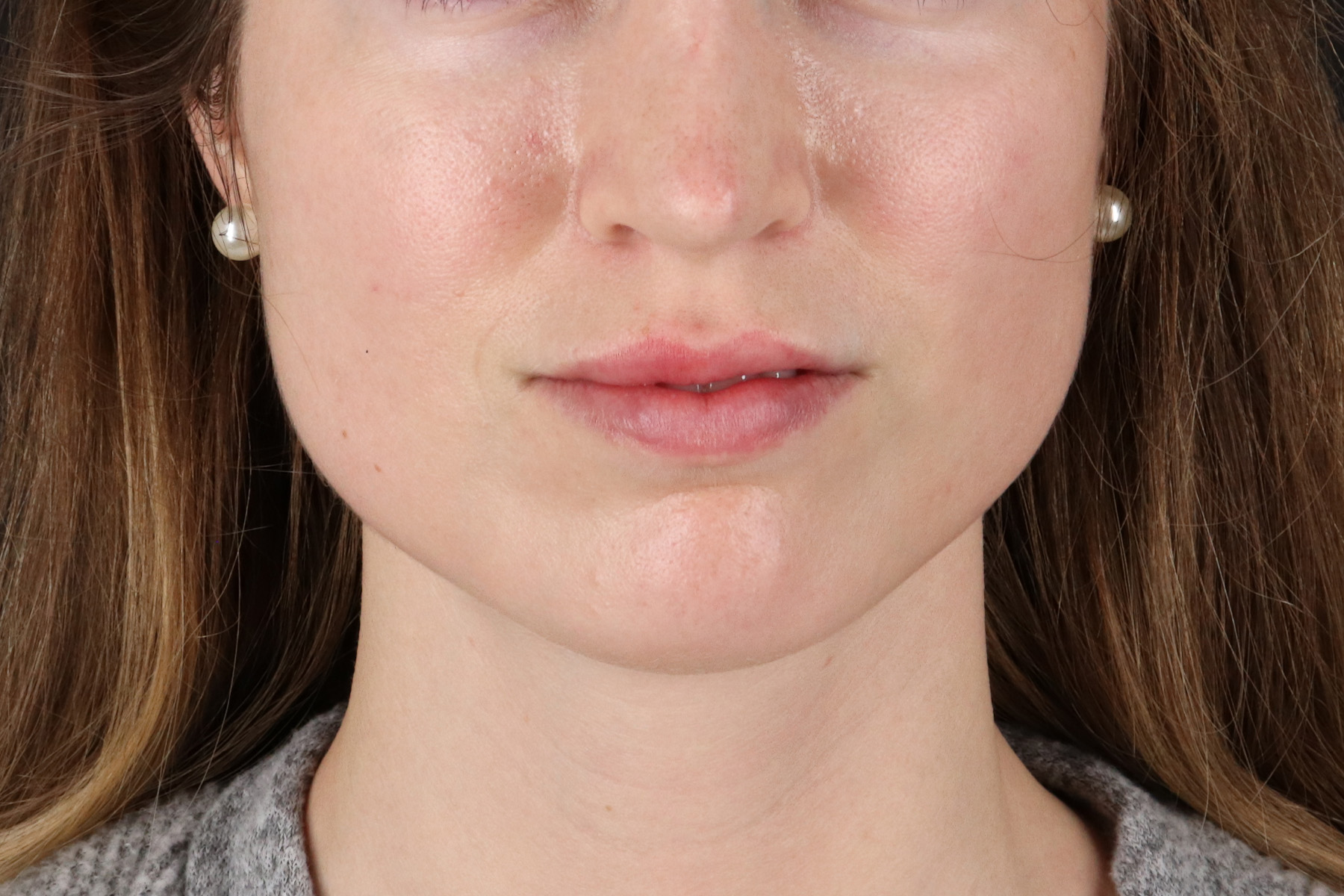 Buccal Fat Pad Before & After Patient #14025