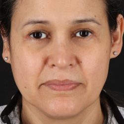 Upper Blepharoplasty Before & After Patient #12018