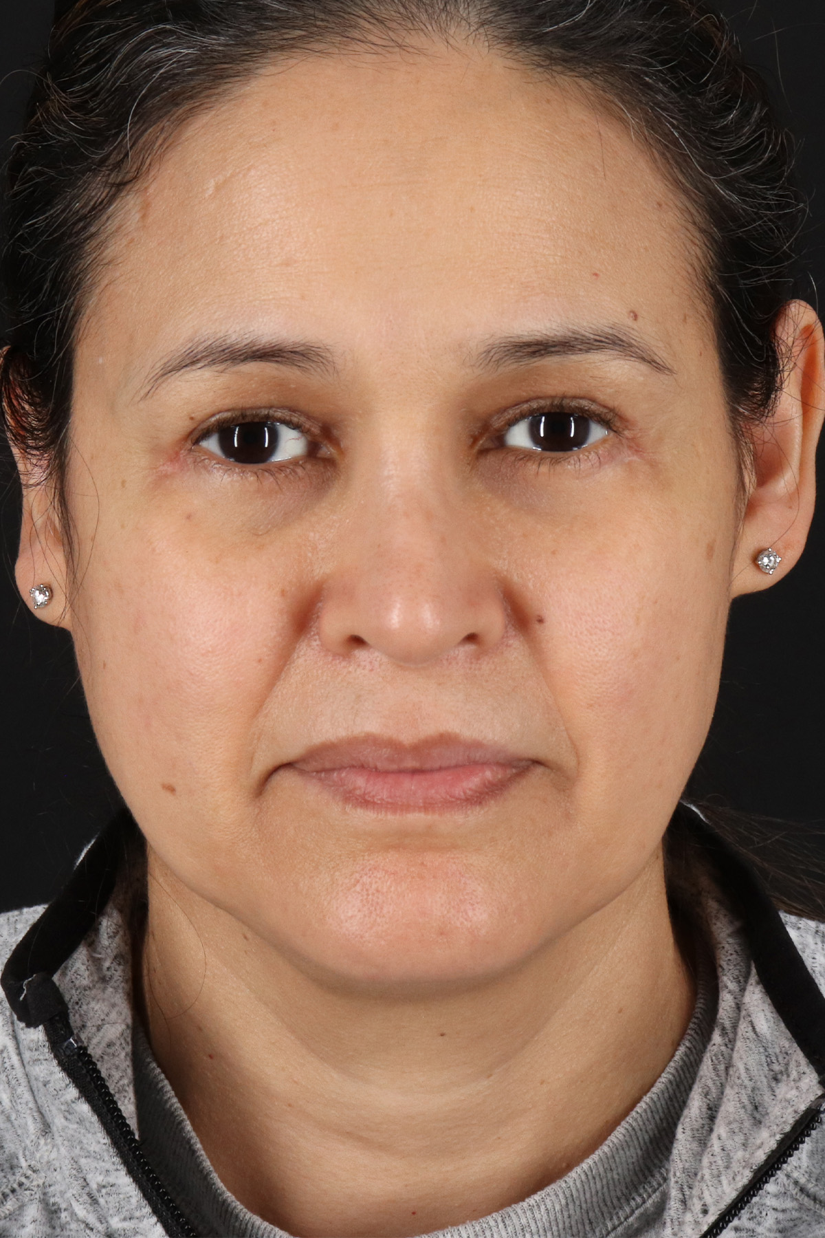 Upper Blepharoplasty Before & After Patient #12018