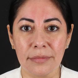 Buccal Fat Pad Before & After Patient #14014
