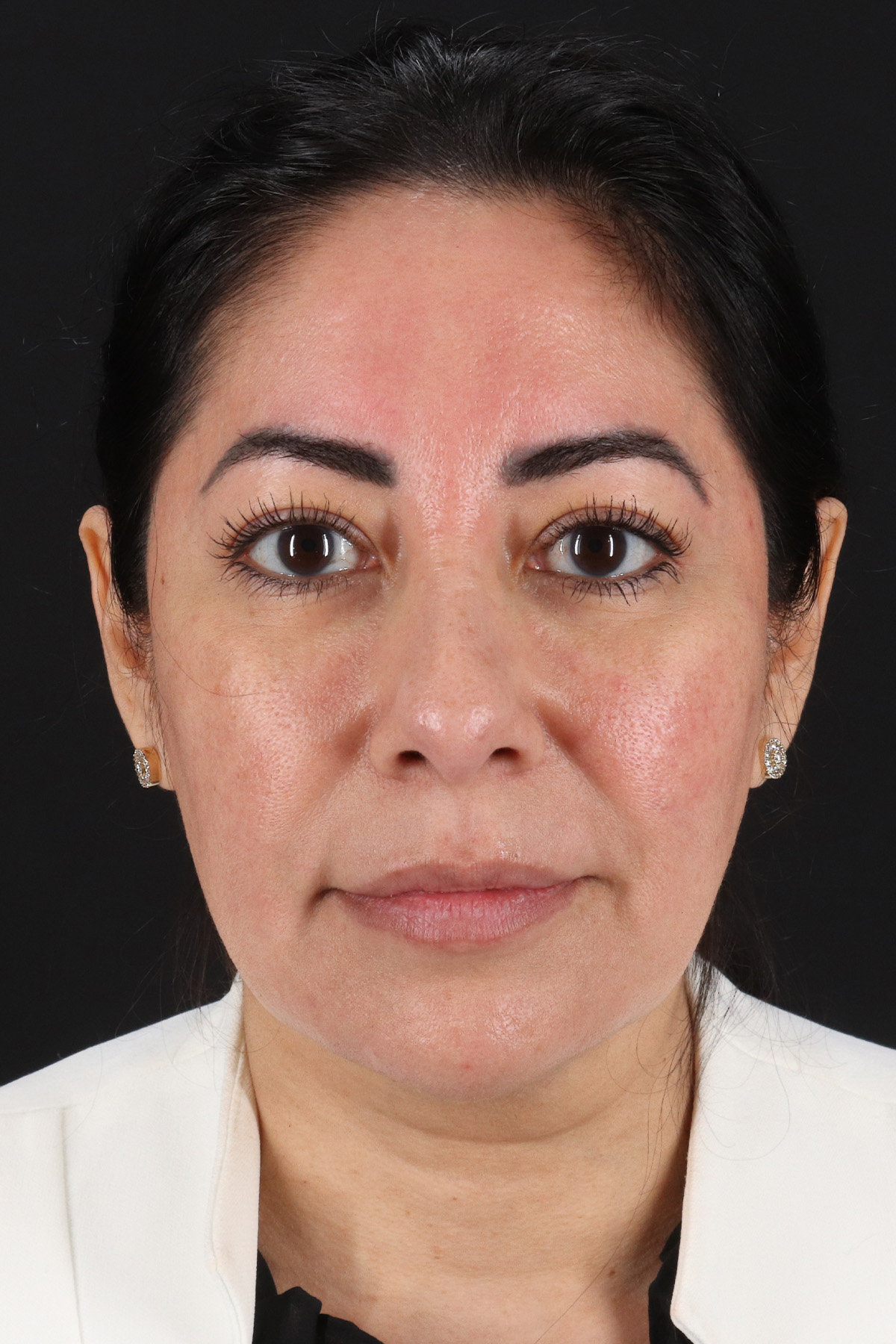 Buccal Fat Pad Before & After Patient #14014