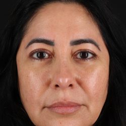 Upper Blepharoplasty Before & After Patient #12062