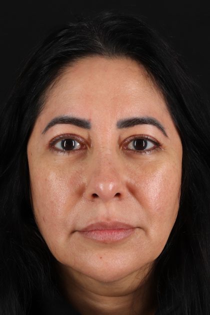 Upper Blepharoplasty Before & After Patient #12062