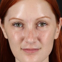 Lower Blepharoplasty Before & After Patient #13008