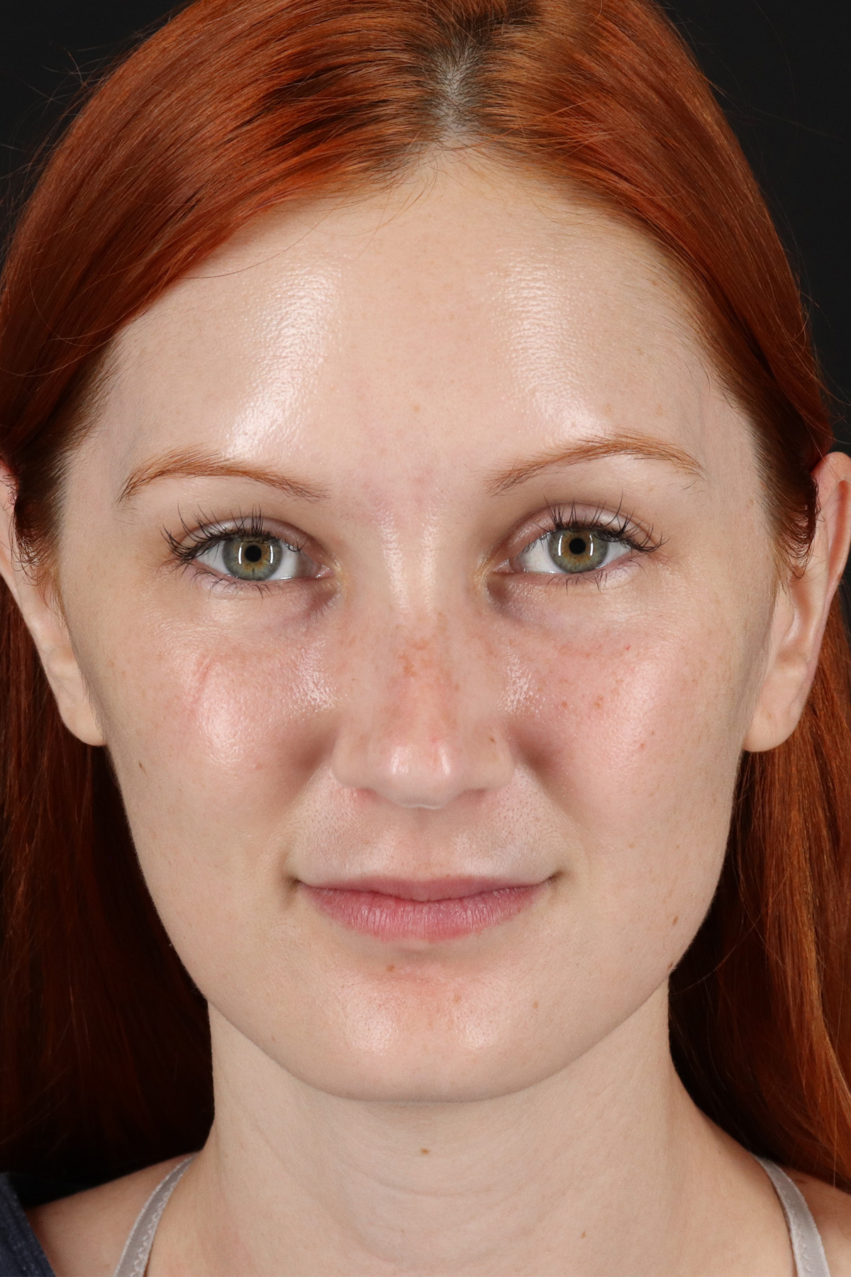 Lower Blepharoplasty Before & After Patient #13008