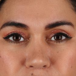 Upper Blepharoplasty Before & After Patient #12007