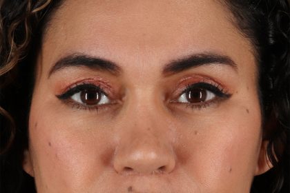 Upper Blepharoplasty Before & After Patient #12007