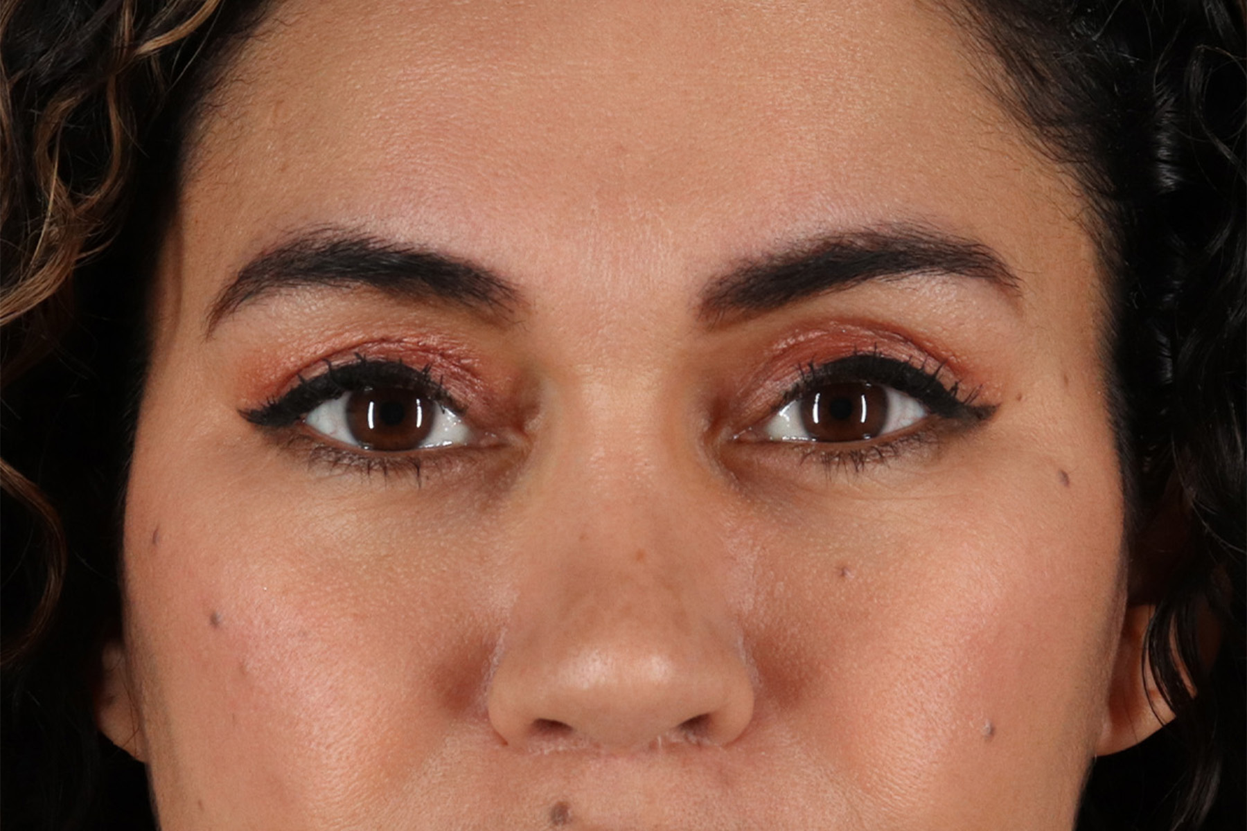 Upper Blepharoplasty Before & After Patient #12007