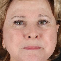 Neck Lift Before & After Patient #11696