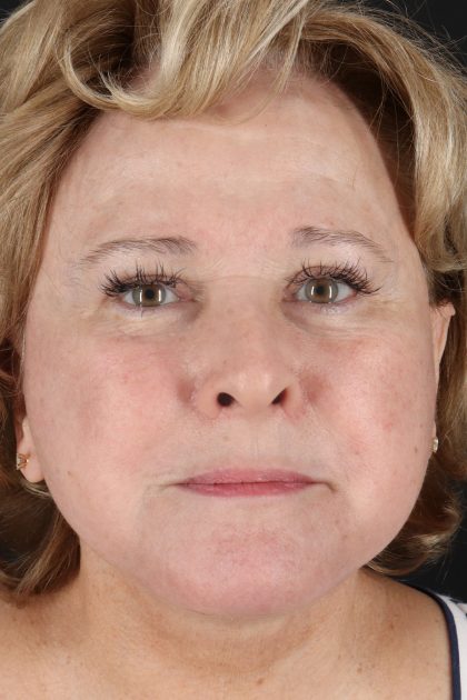 Facelift Before & After Patient #11695