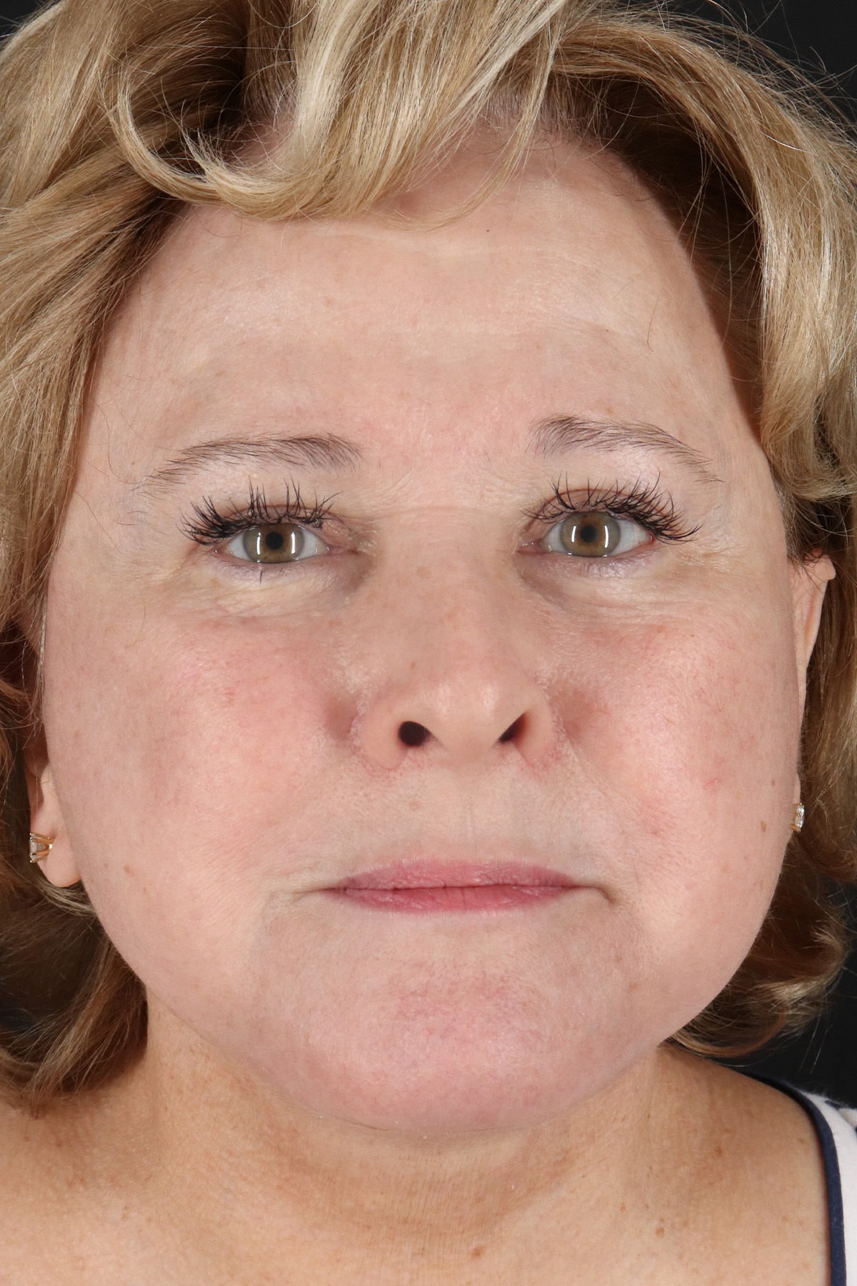Facelift Before & After Patient #11695