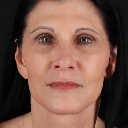 Neck Lift Before & After Patient #12887