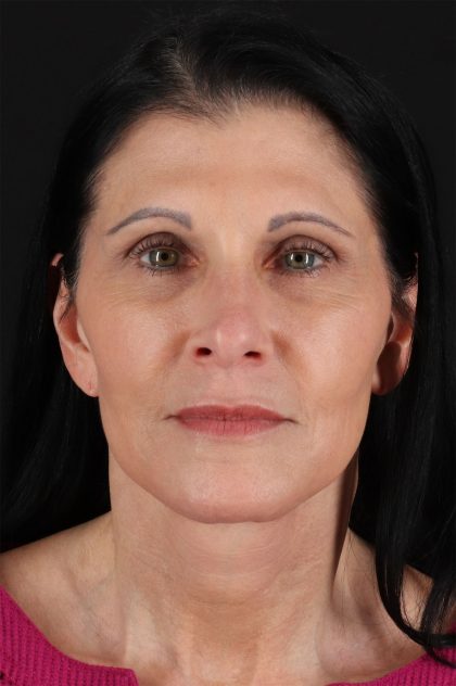 Neck Lift Before & After Patient #12887