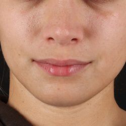 Chin Implant Before & After Patient #13750