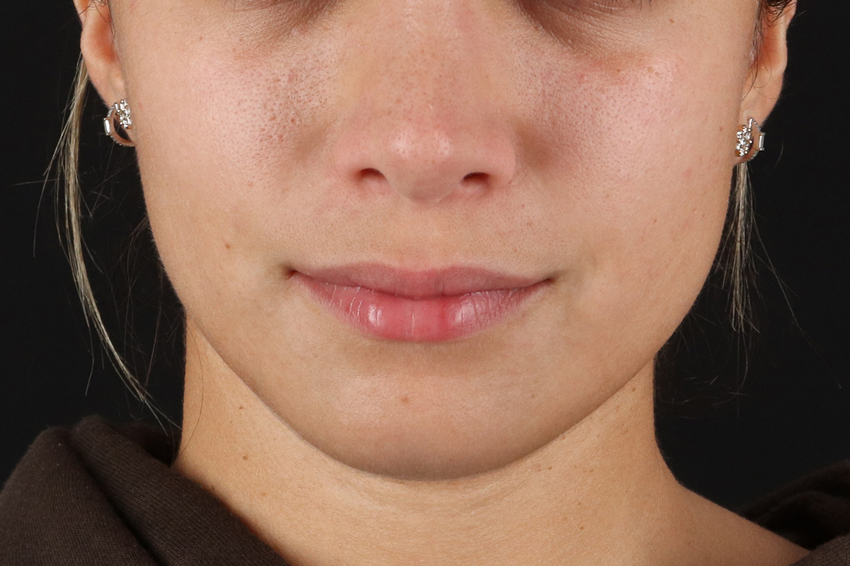 Chin Implant Before & After Patient #13750