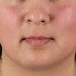 Chin Implant Before & After Patient #13794