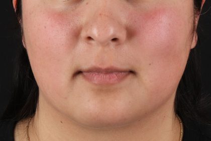 Chin Implant Before & After Patient #13794