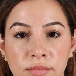 Rhinoplasty Before & After Patient #12271