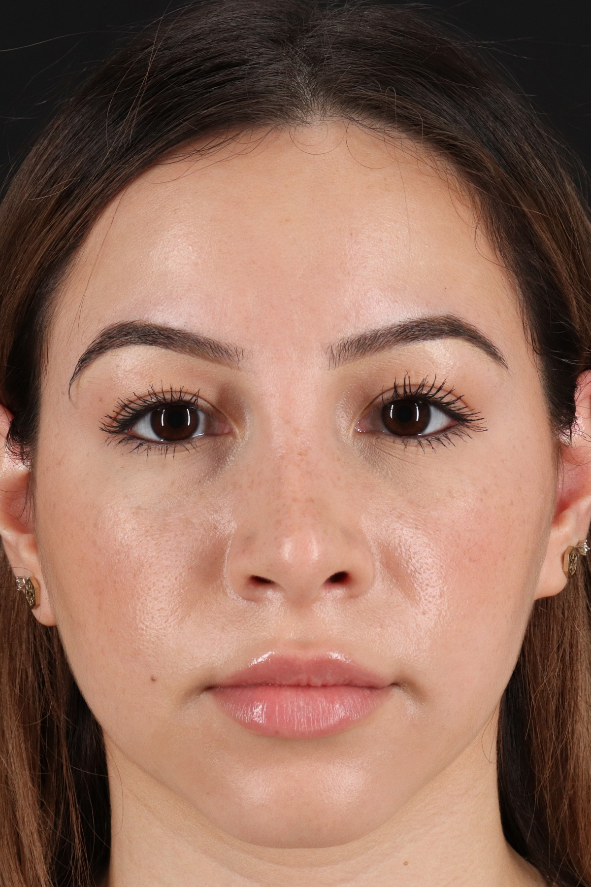 Rhinoplasty Before & After Patient #12271