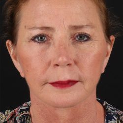 Lower Blepharoplasty Before & After Patient #13074