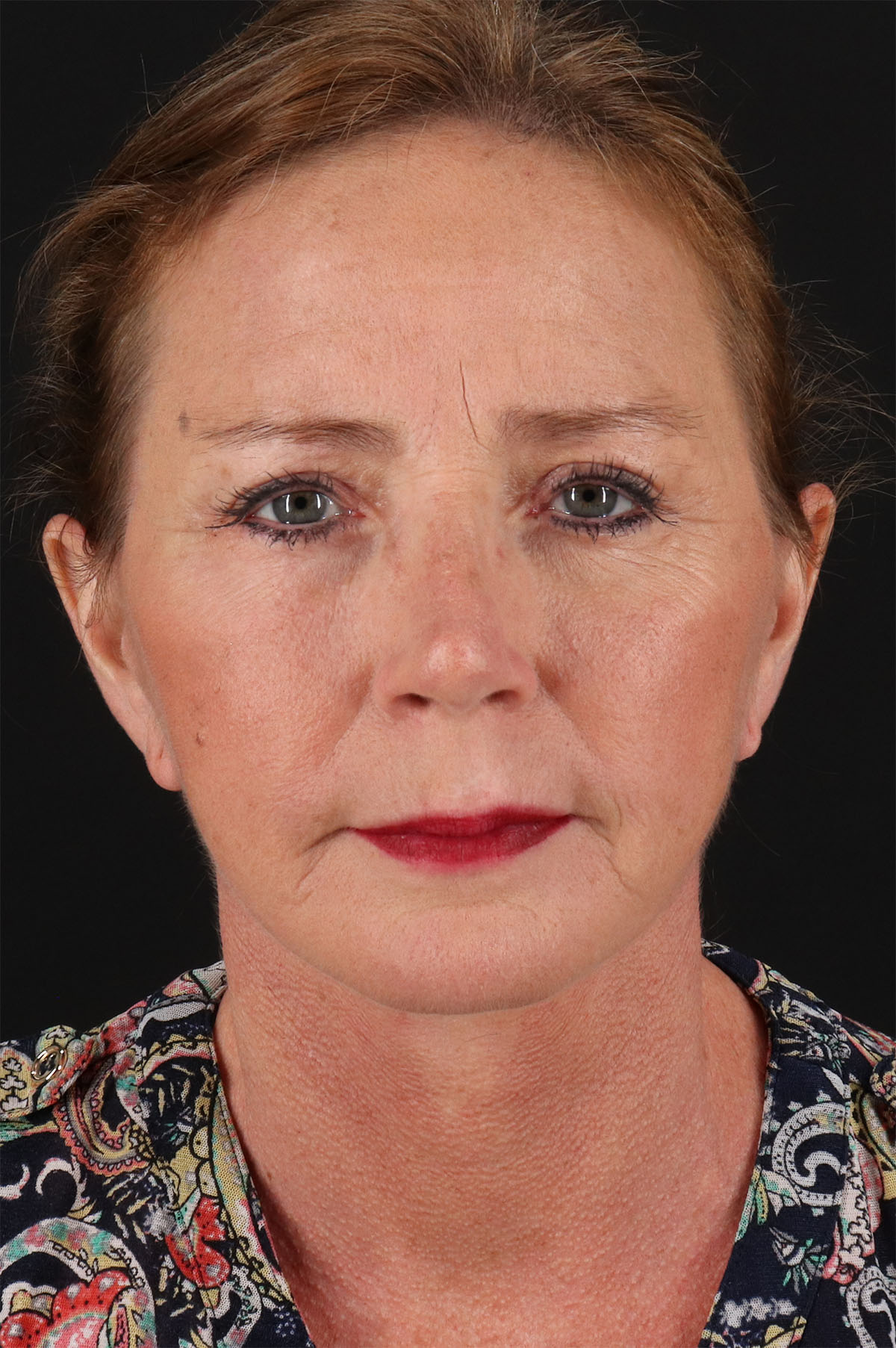 Lower Blepharoplasty Before & After Patient #13074