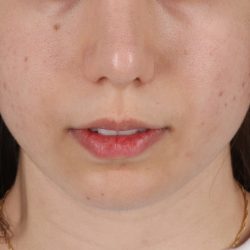 Chin Implant Before & After Patient #13772