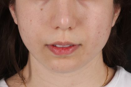 Chin Implant Before & After Patient #13772
