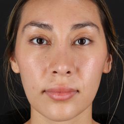 Rhinoplasty Before & After Patient #12480