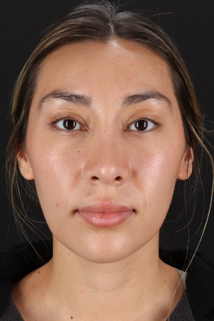 Rhinoplasty Before & After Patient #12480