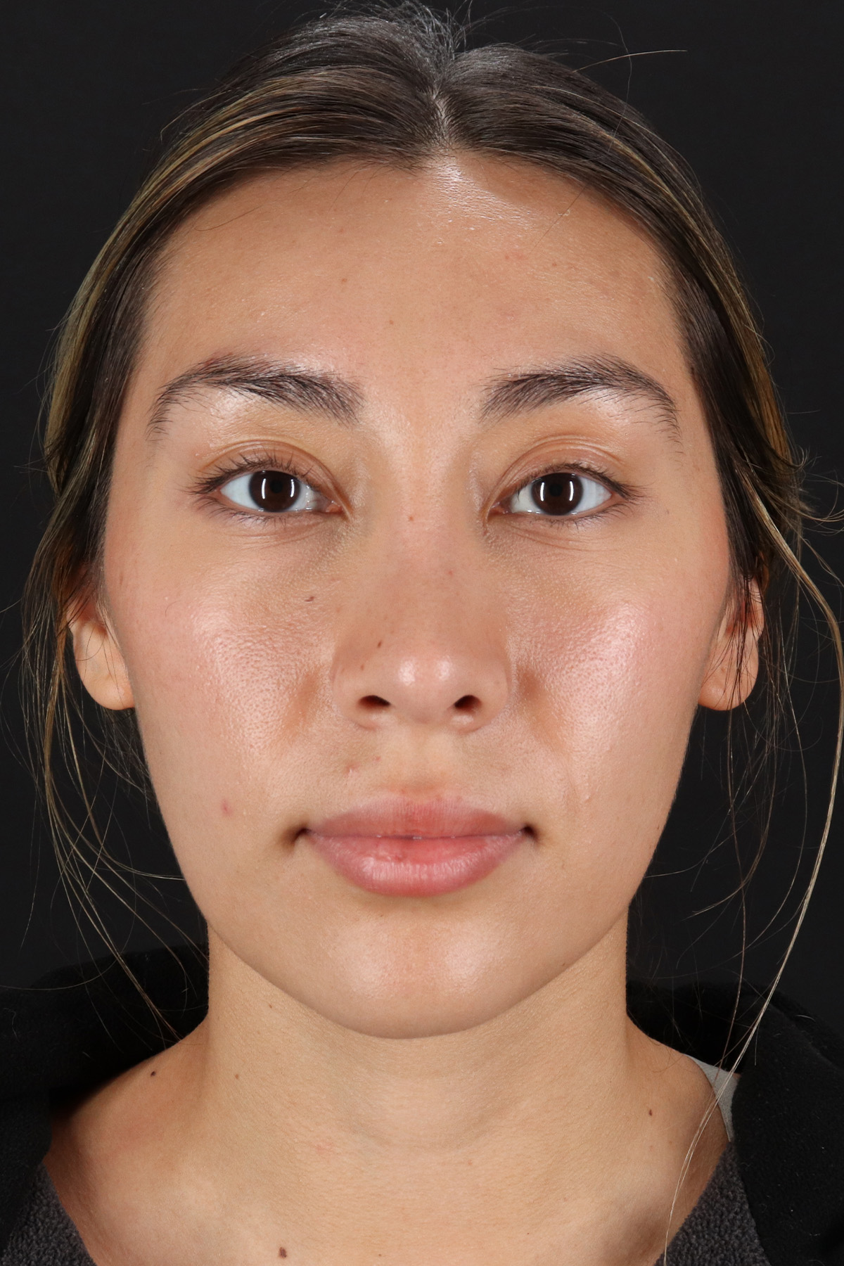 Rhinoplasty Before & After Patient #12480