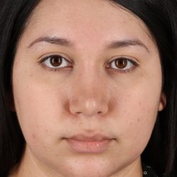 Chin Implant Before & After Patient #13739