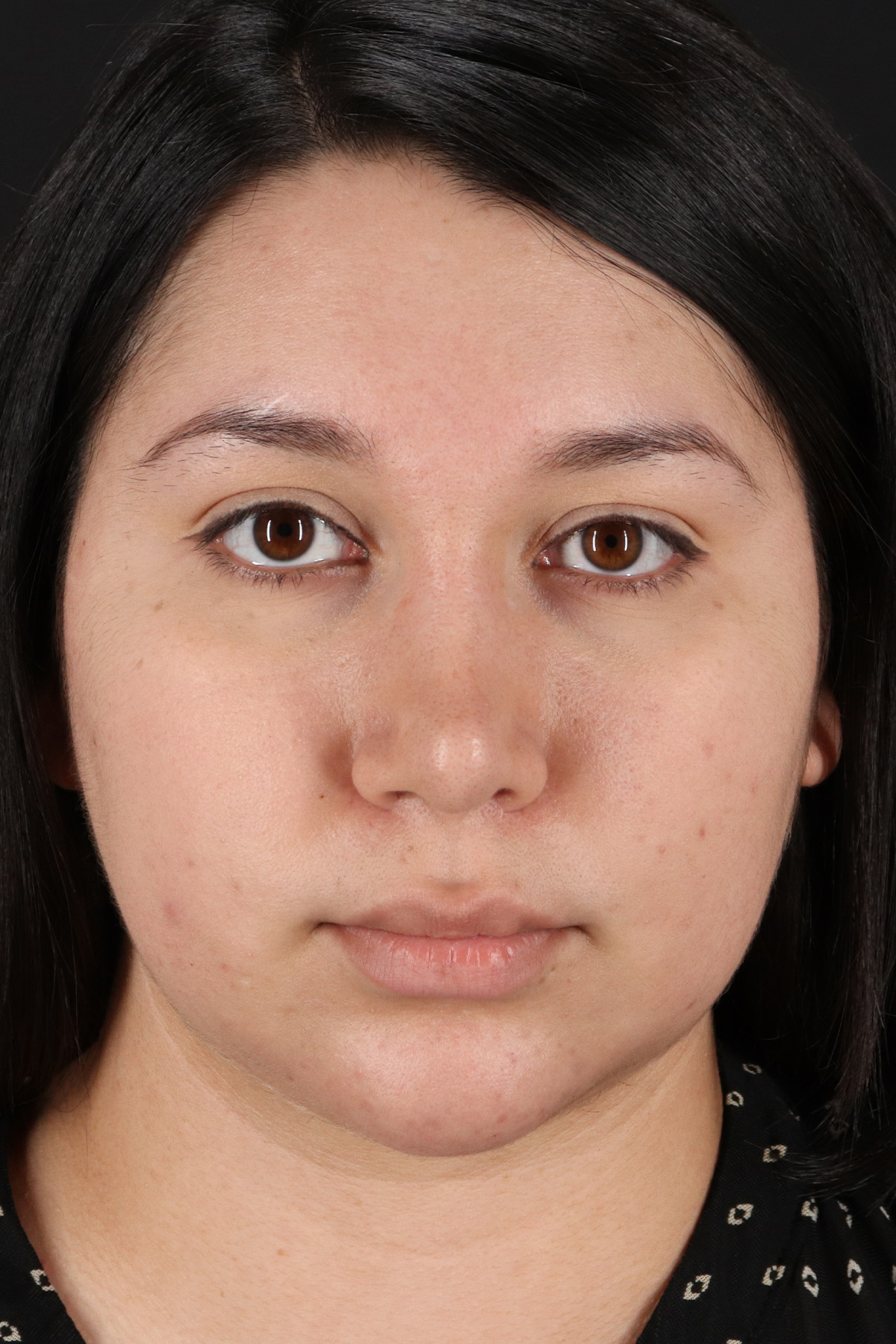 Chin Implant Before & After Patient #13739