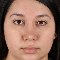 Neck Lift Before & After Patient #11698