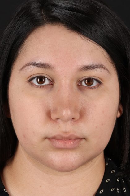 Neck Lift Before & After Patient #11698