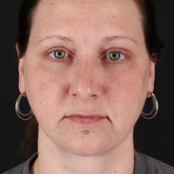Lower Blepharoplasty Before & After Patient #13052