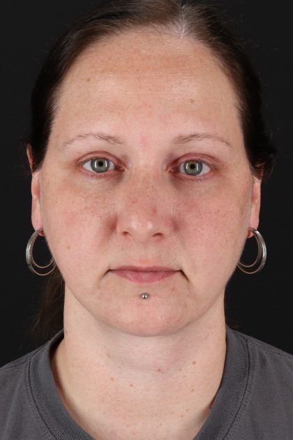 Lower Blepharoplasty Before & After Patient #13052