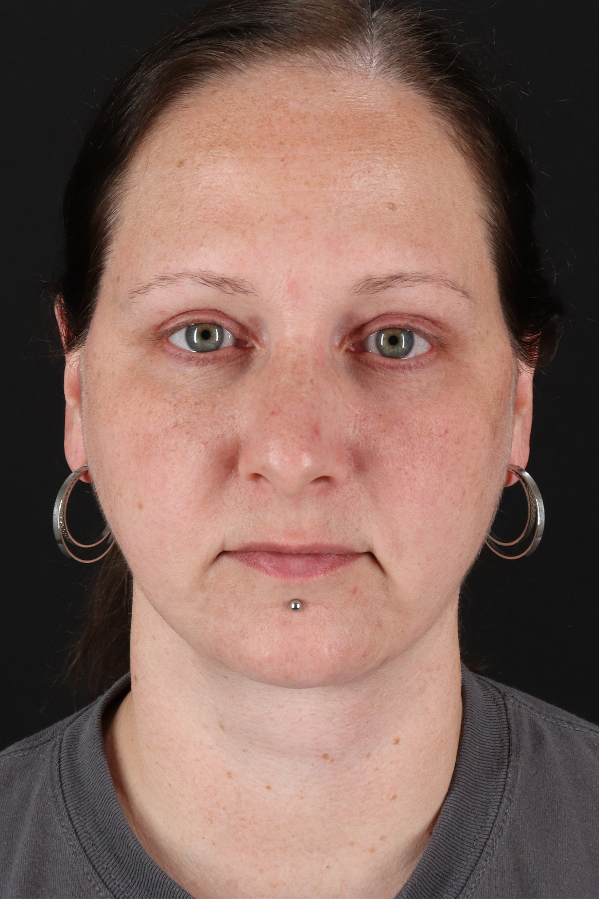 Lower Blepharoplasty Before & After Patient #13052