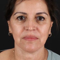 Lower Blepharoplasty Before & After Patient #13063