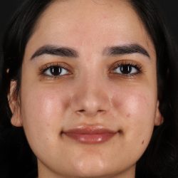 Rhinoplasty Before & After Patient #12436