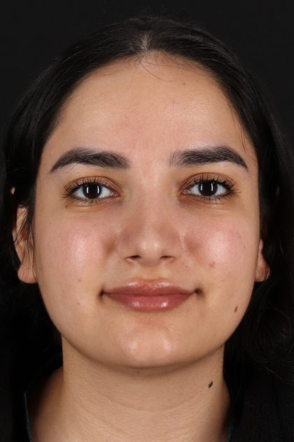 Rhinoplasty Before & After Patient #12436