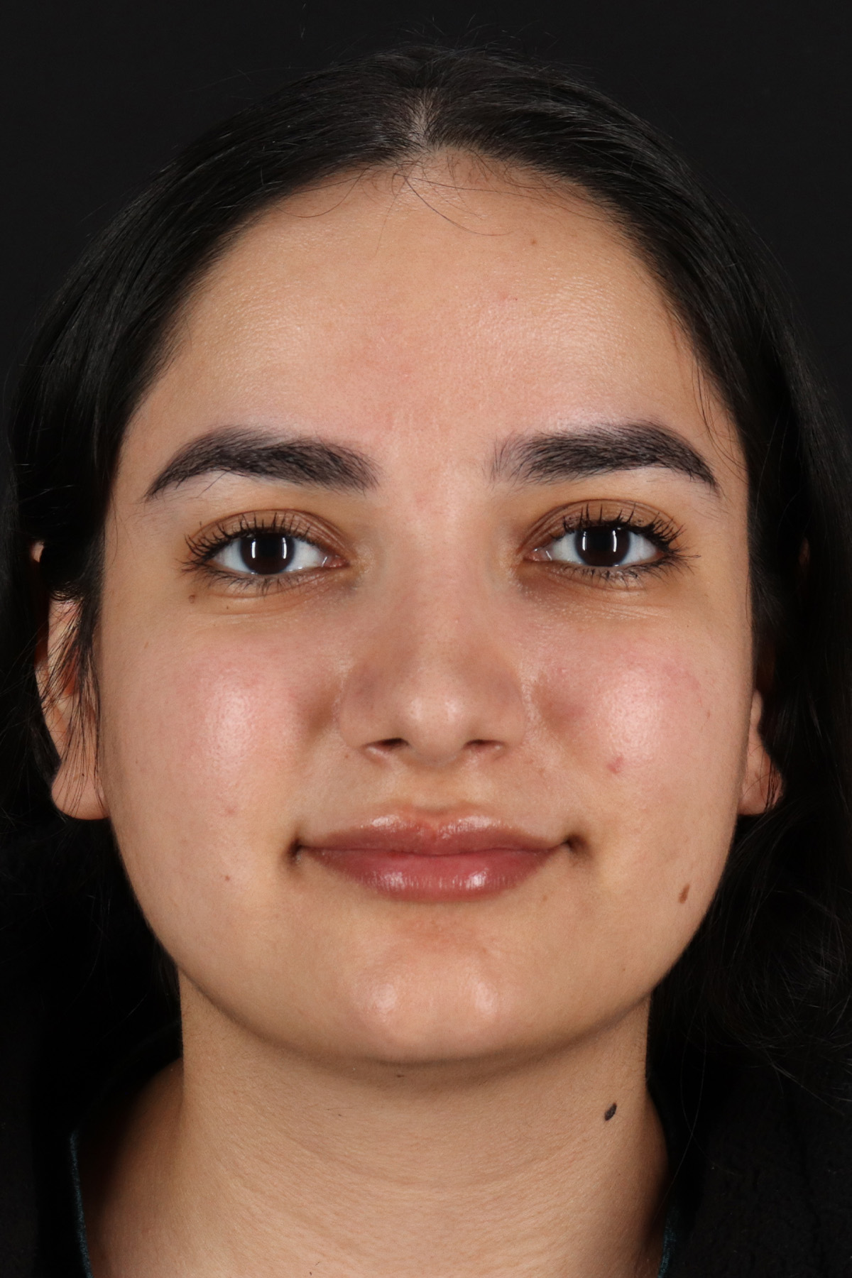Rhinoplasty Before & After Patient #12436