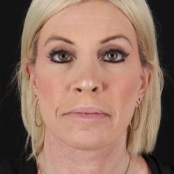 Upper Blepharoplasty Before & After Patient #12095